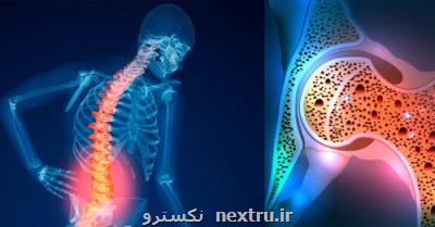 دردسرهای پوكی استخوان و شكستگی در سنین بالای 50 سال