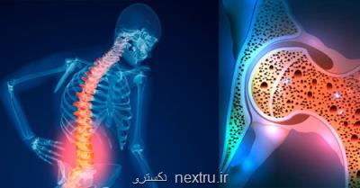 شیوع بالای پوکی استخوان در سنین بالای 50