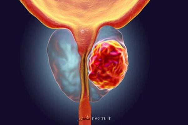 روشی برای تعیین دوز مناسب مواد پرتوزا در درمان سرطان پروستات