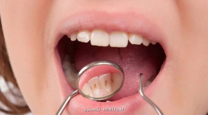 تأثیر عصاره رزماری و میخك بر باكتری های عامل پوسیدگی دندان